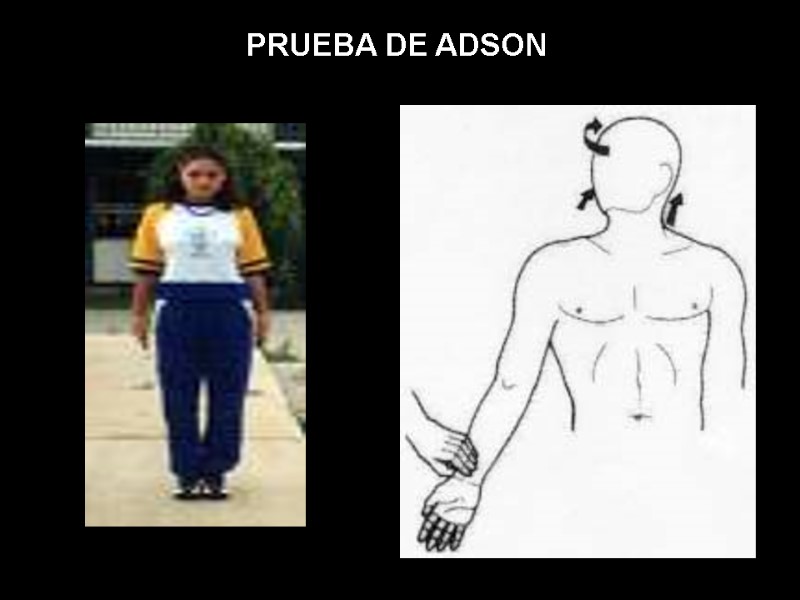 PRUEBA DE ADSON